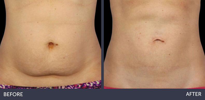 Abilene Plastic Surgery & Medspa CoolSculpting non-surgical fat reduction of the stomach before & after photo in Abilene, TX
