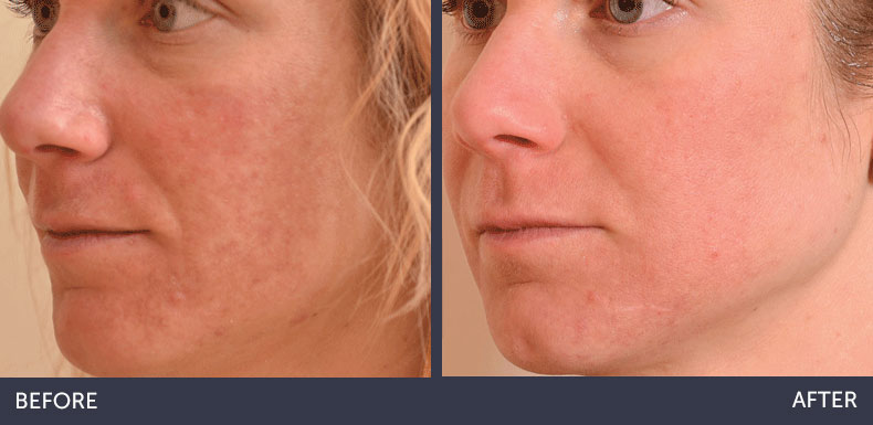 Abilene Plastic Surgery & Medspa halo laser skin renewal before & after photo in Abilene, TX