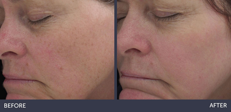 Abilene Plastic Surgery & Medspa halo laser skin renewal before & after photo in Abilene, TX
