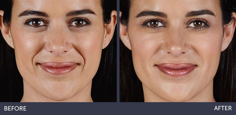 Abilene Plastic Surgery & Medspa dermal fillers before & after photo in Abilene, TX